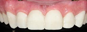 Smile gallery case 1 — after treatment