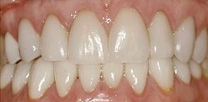 Smile gallery case 2 — after treatment