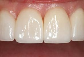 Smile gallery case 7 — after treatment