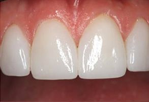 Smile gallery case 8 — after treatment