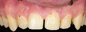Smile gallery case 1 — before treatment