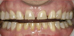 Smile gallery case 2 — before treatment