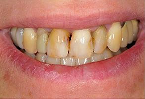 Smile gallery case 3 — before treatment