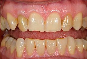 Smile gallery case 4 — before treatment