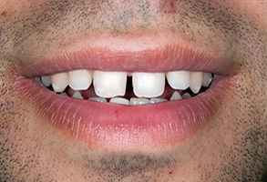 Smile gallery case 5 — before treatment