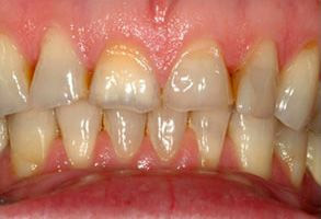 Smile gallery case 6 — before treatment