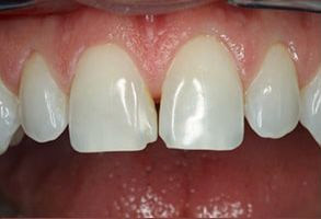 Smile gallery case 8 — before treatment